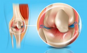 Joint Pain: A Consequence of Carelessness